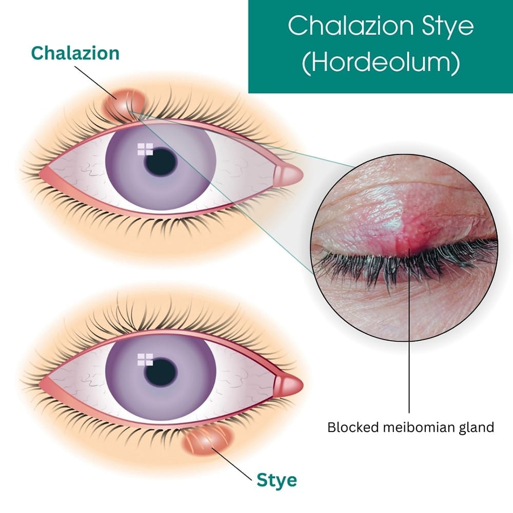 Internal Stye Vs Chalazion Chalazion Removal London