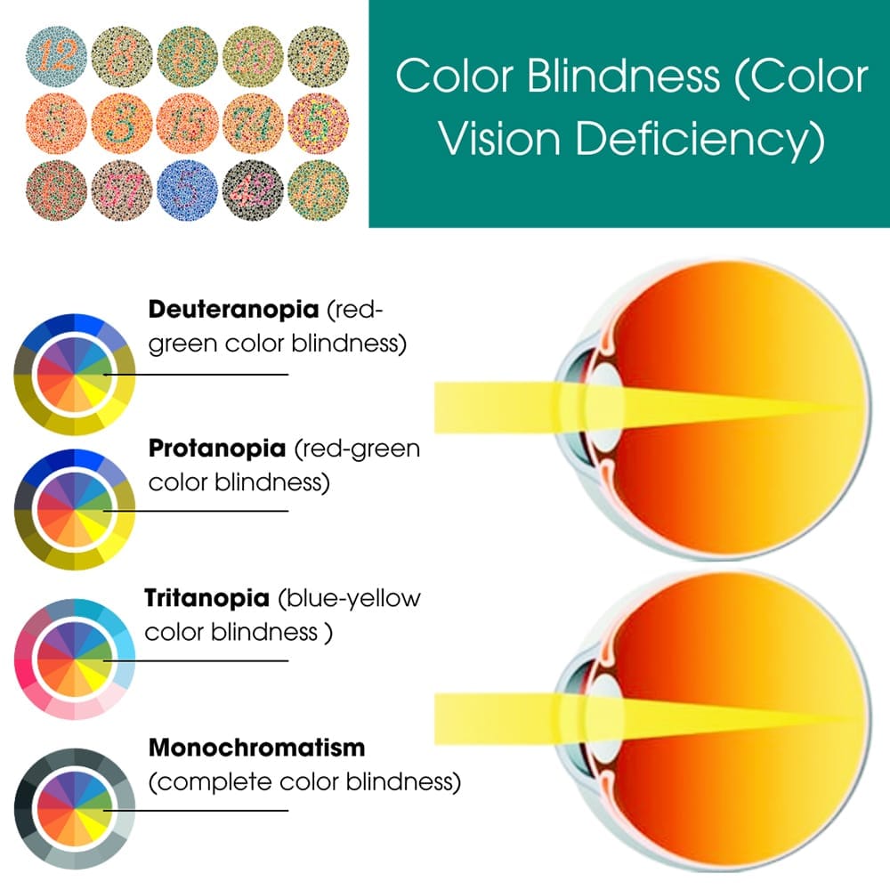 Color Blindness (Color Vision Deficiency)