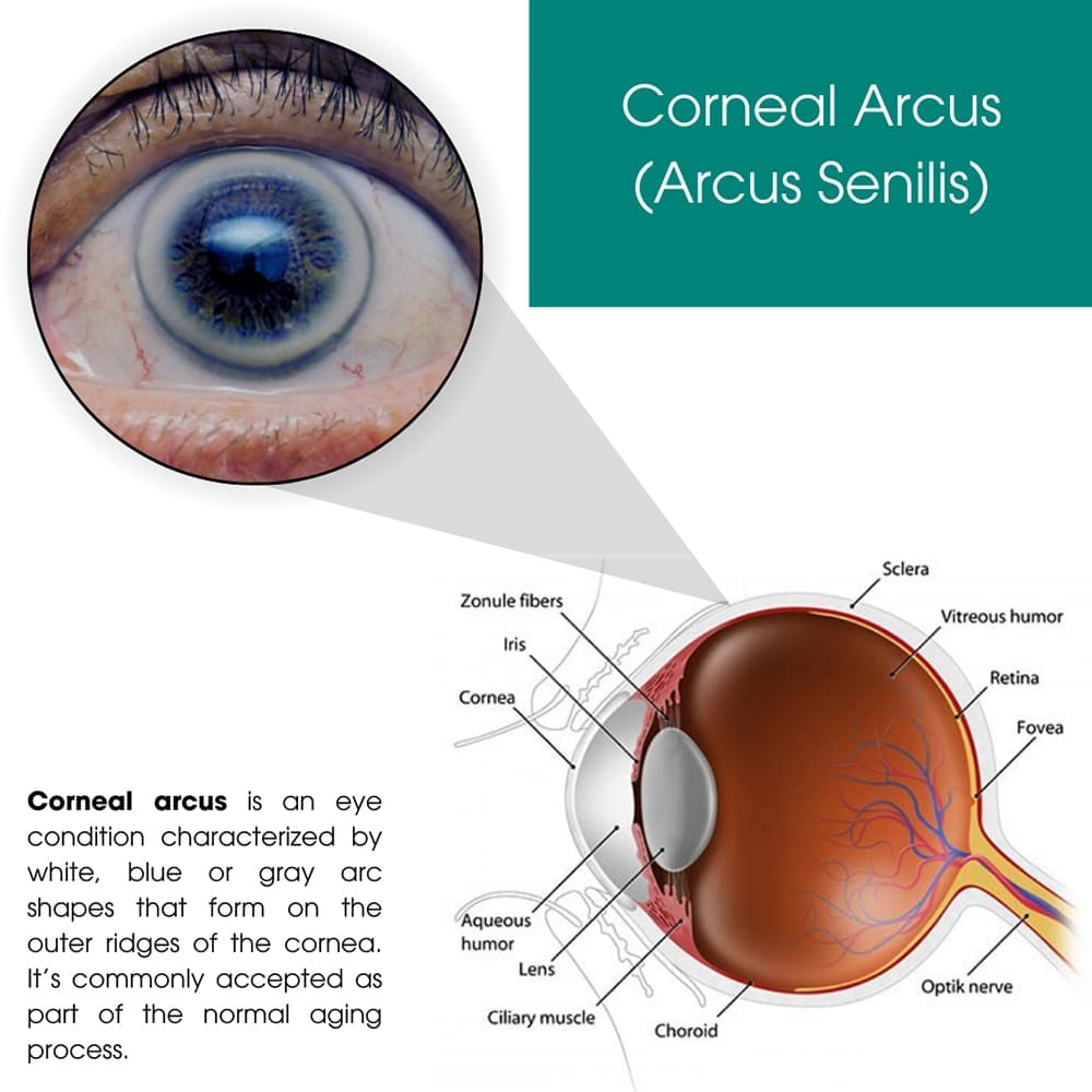 Corneal Arcus (Arcus Senilis)