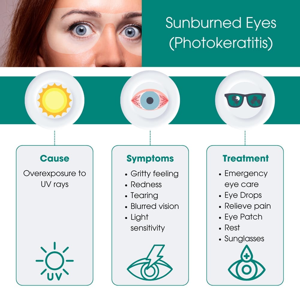Sunburned Eyes (Photokeratitis)