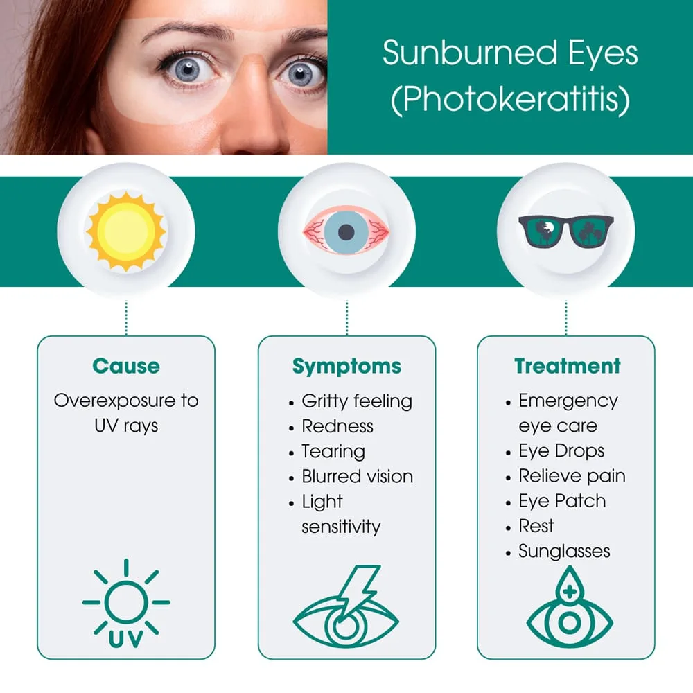 photokeratitis symptoms eye sunburn