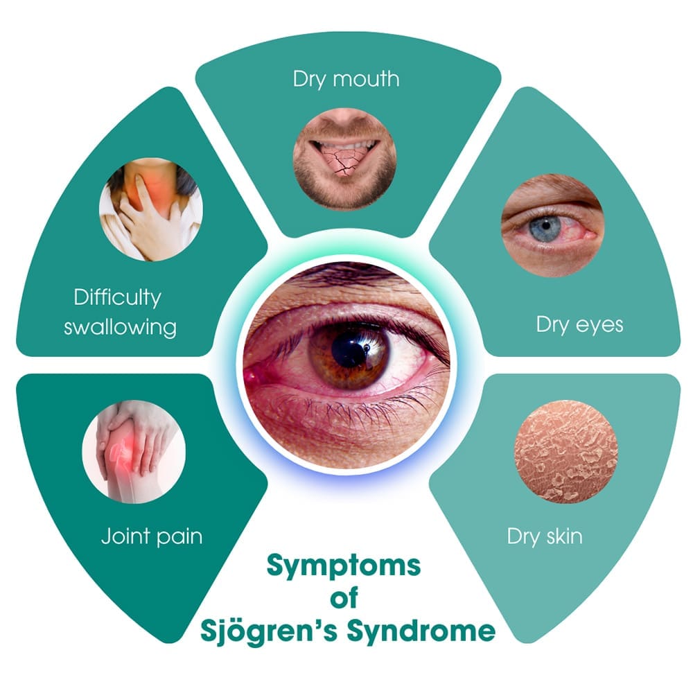 Symptoms of Sjögren’s Syndrome